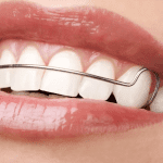 retenedores dentales